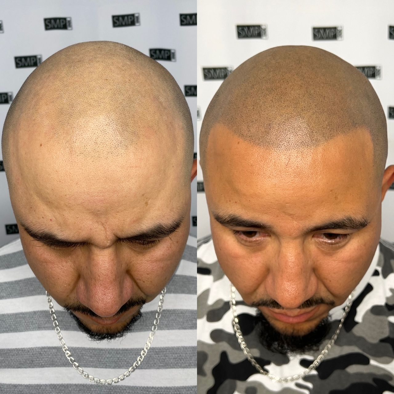 Before and after photos of a man's scalp. The right photo shows a hair tattoo.