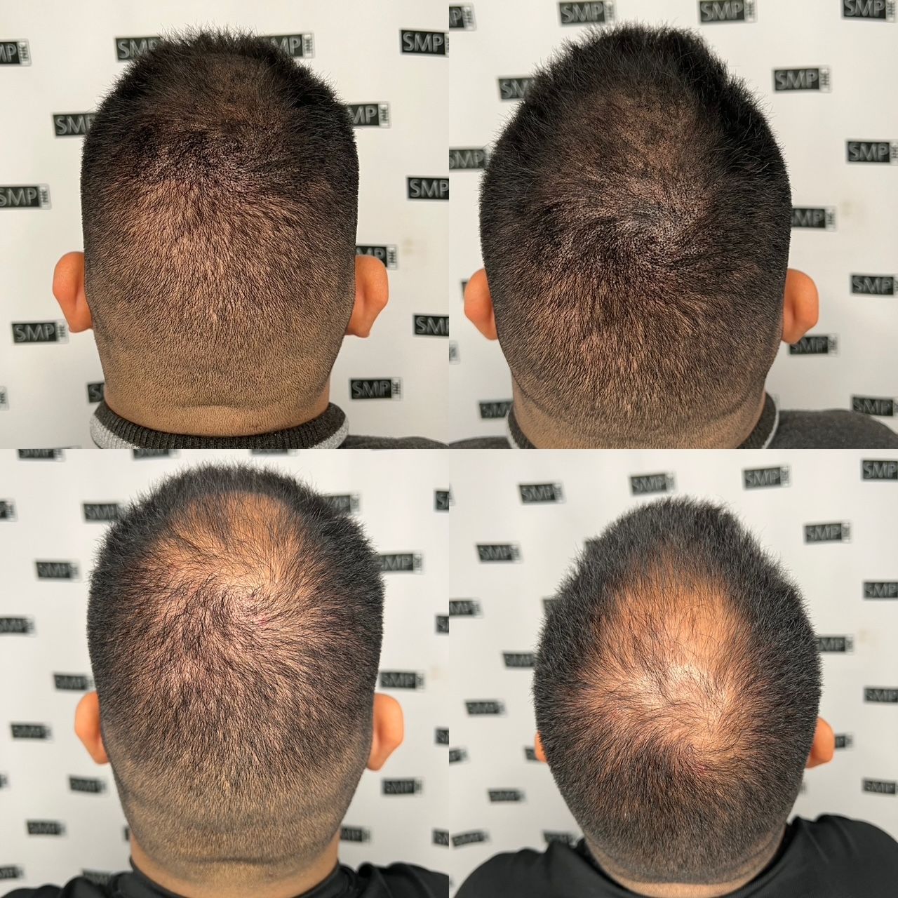 Four views of a man's head, showing varying degrees of hair loss; likely a progression of a hair restoration treatment.