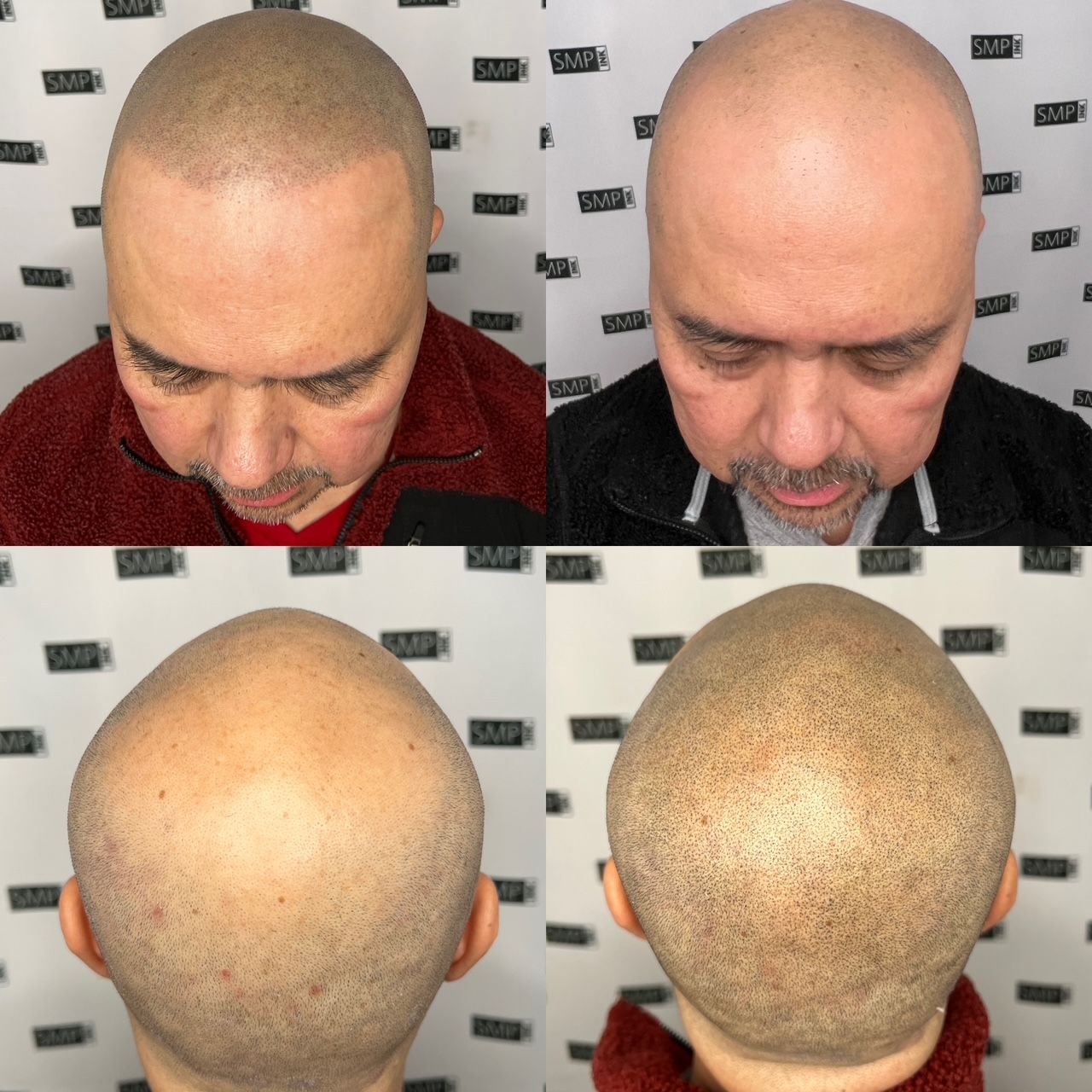 A man's head, before and after scalp micropigmentation. Front and back views, bald head filled with tiny dots.