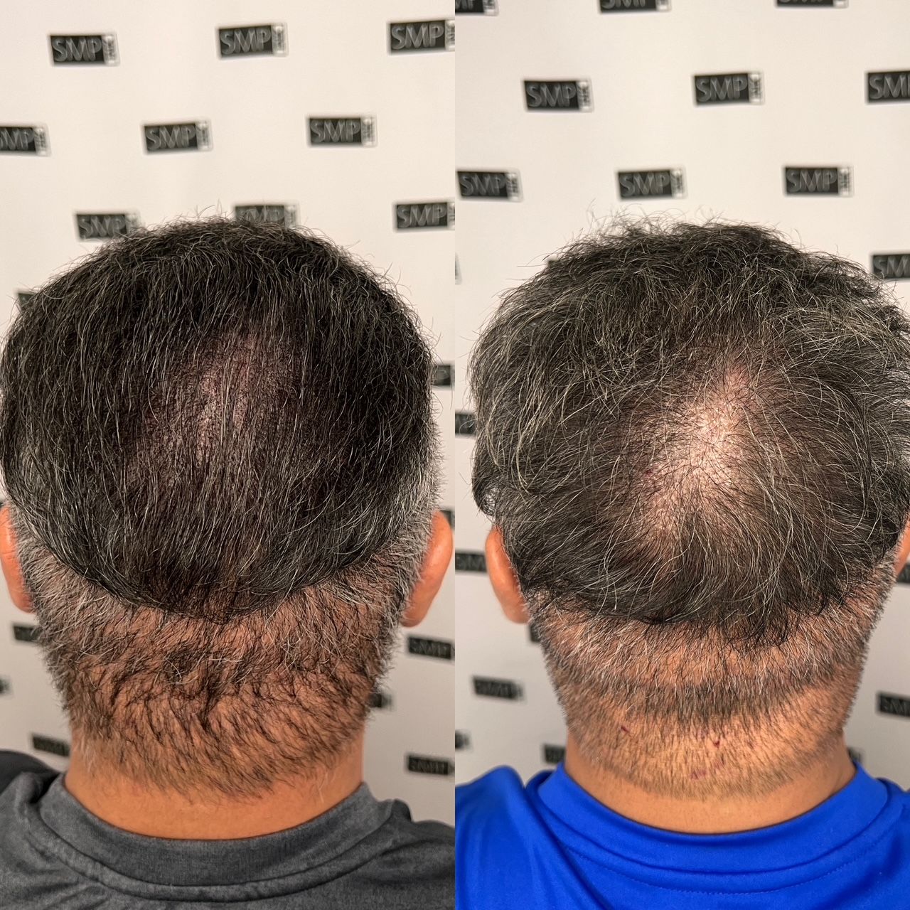 Two back-view photos of a man's head, showing hair loss before (left) and after (right) a treatment.