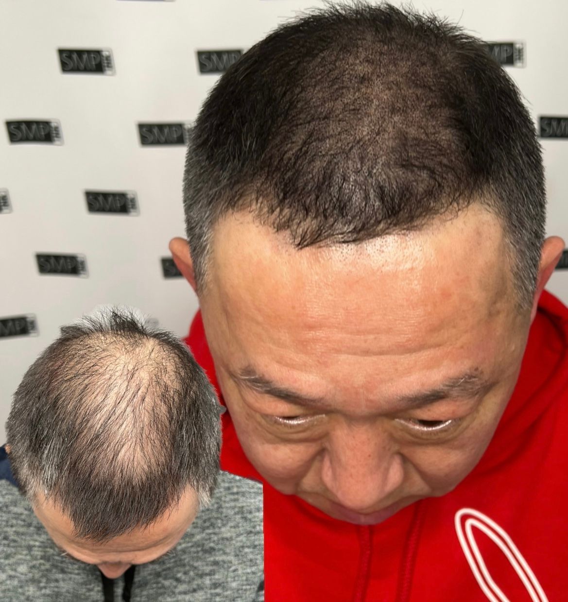 Man with balding head, shows hair growth after treatment, set in a clinic.