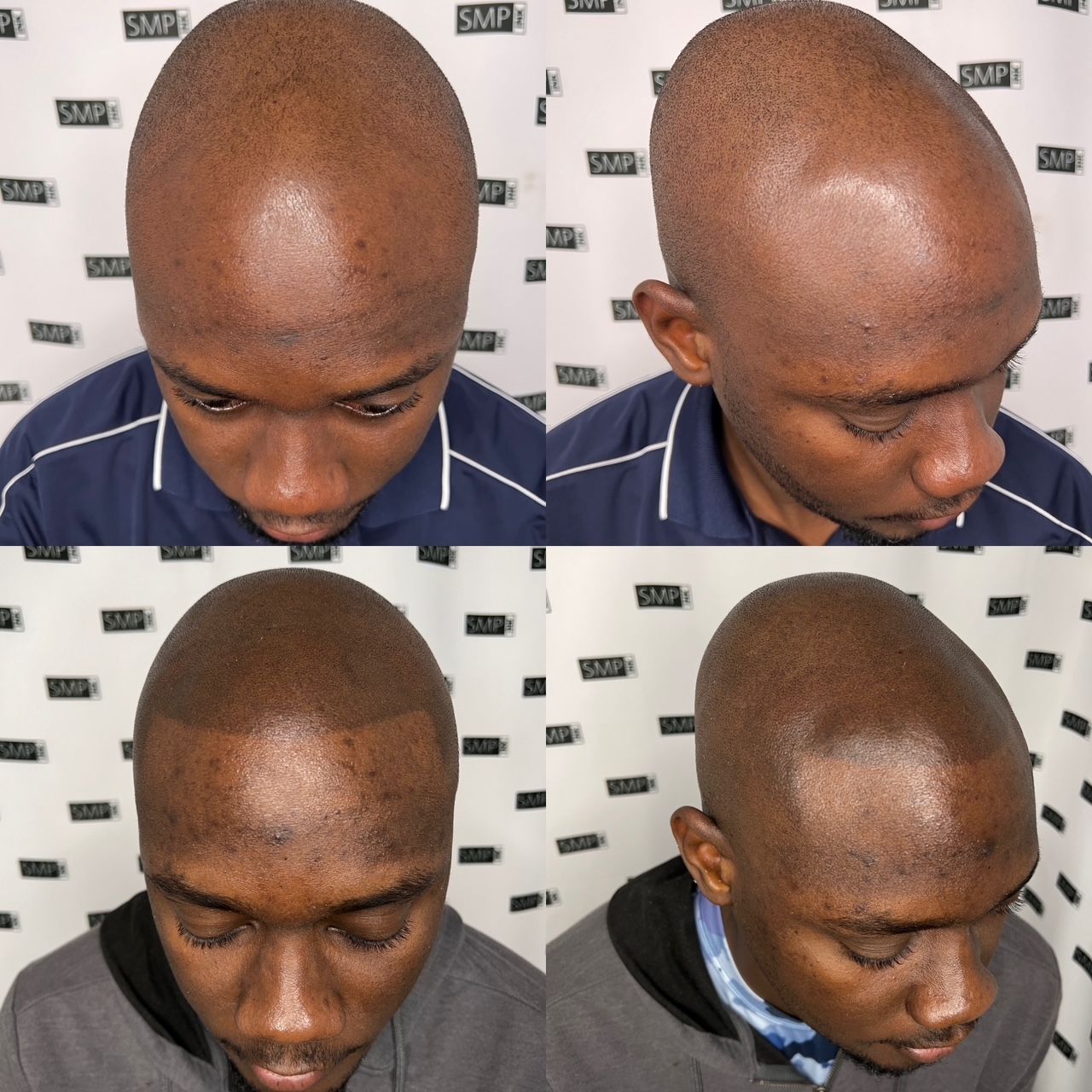 Four views of a Black man's scalp after scalp micropigmentation; mimicking a closely shaved head.