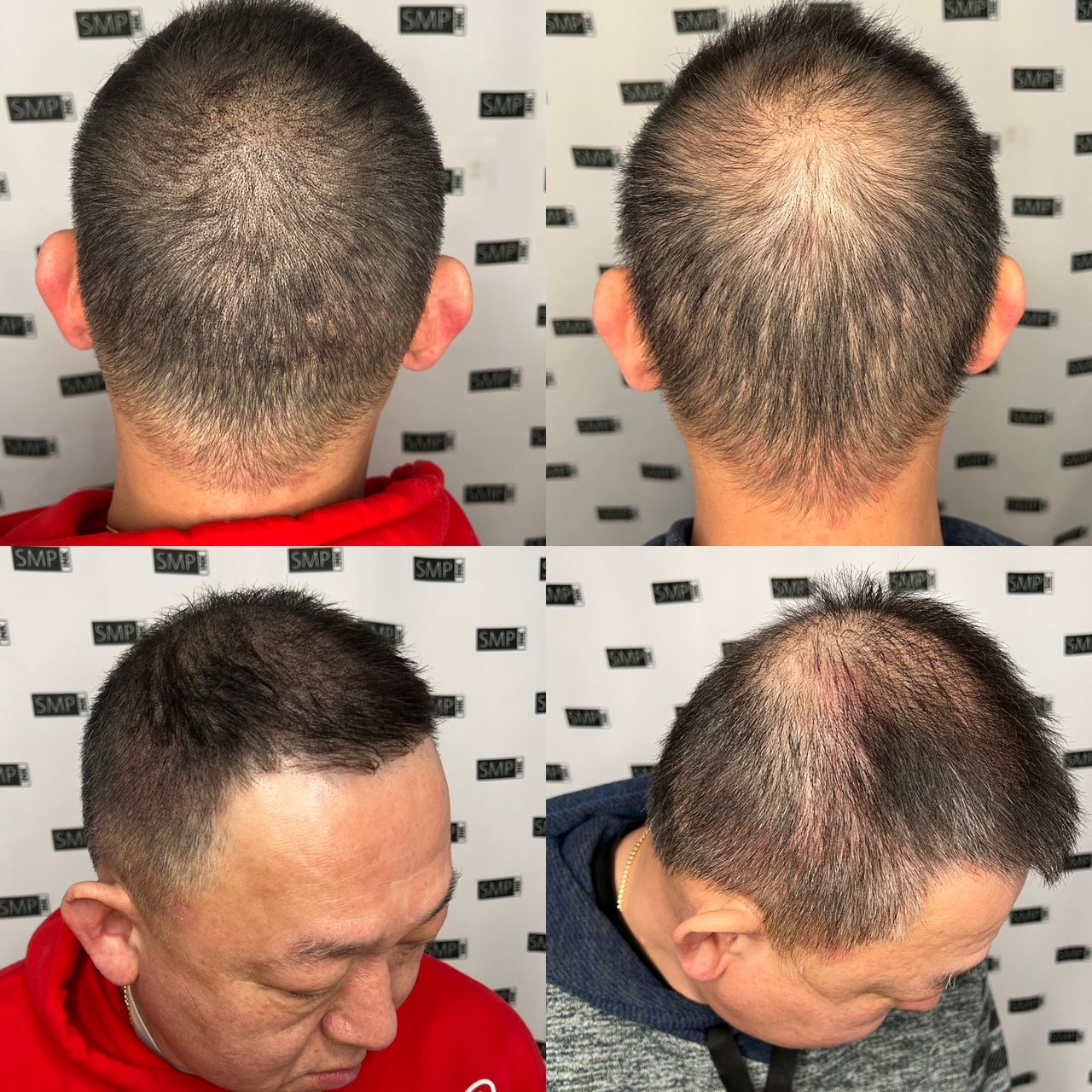 Four images of a man with thinning hair, showing different angles of his head and haircut progress.