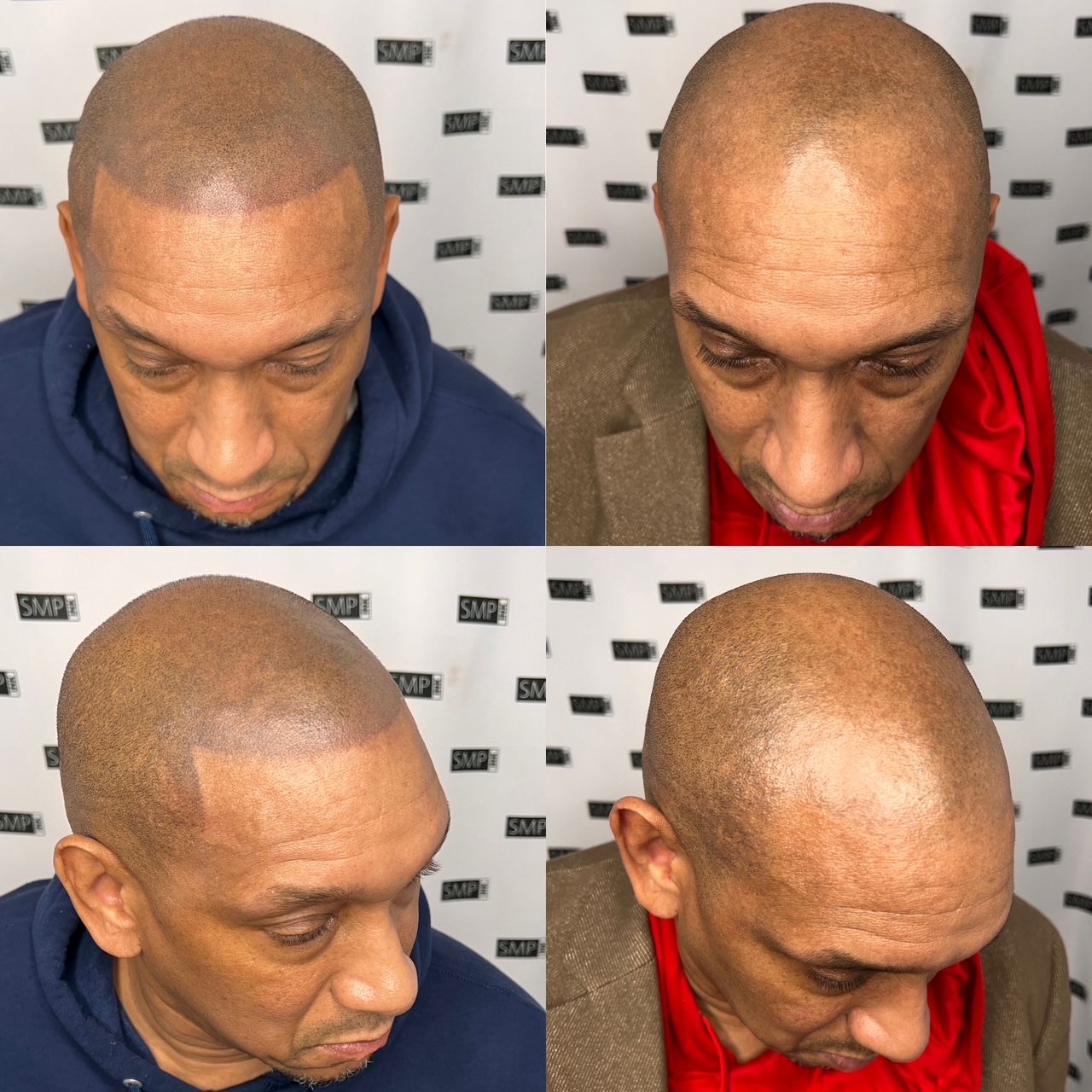 Man with shaved head, undergoing scalp micropigmentation, various angles. Skin-tone, brown, close-up.