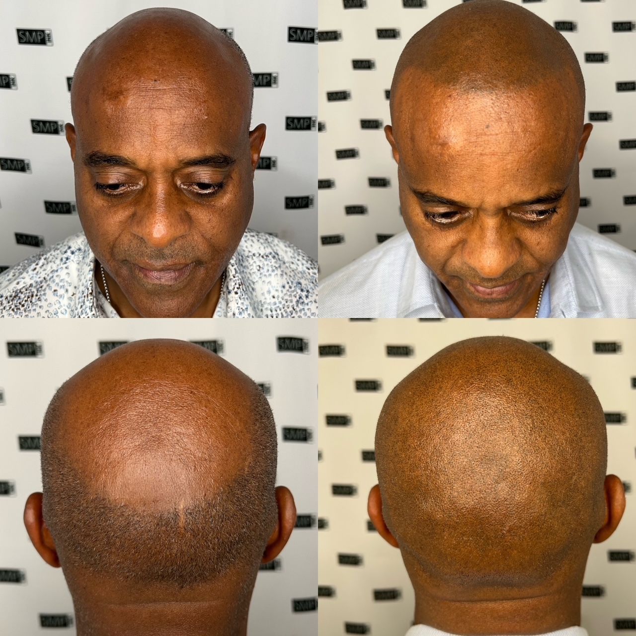 Man with shaved head; before and after scalp micropigmentation to simulate a full head of hair.