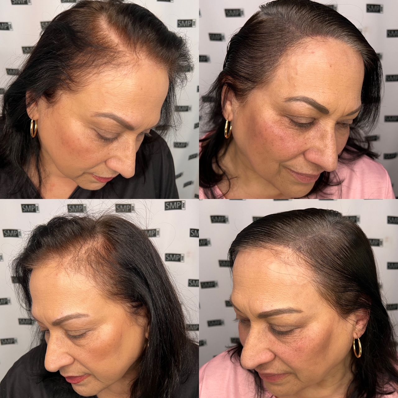 Side-by-side photos of a woman with receding hairline, showing hair growth progress after a hair loss treatment.