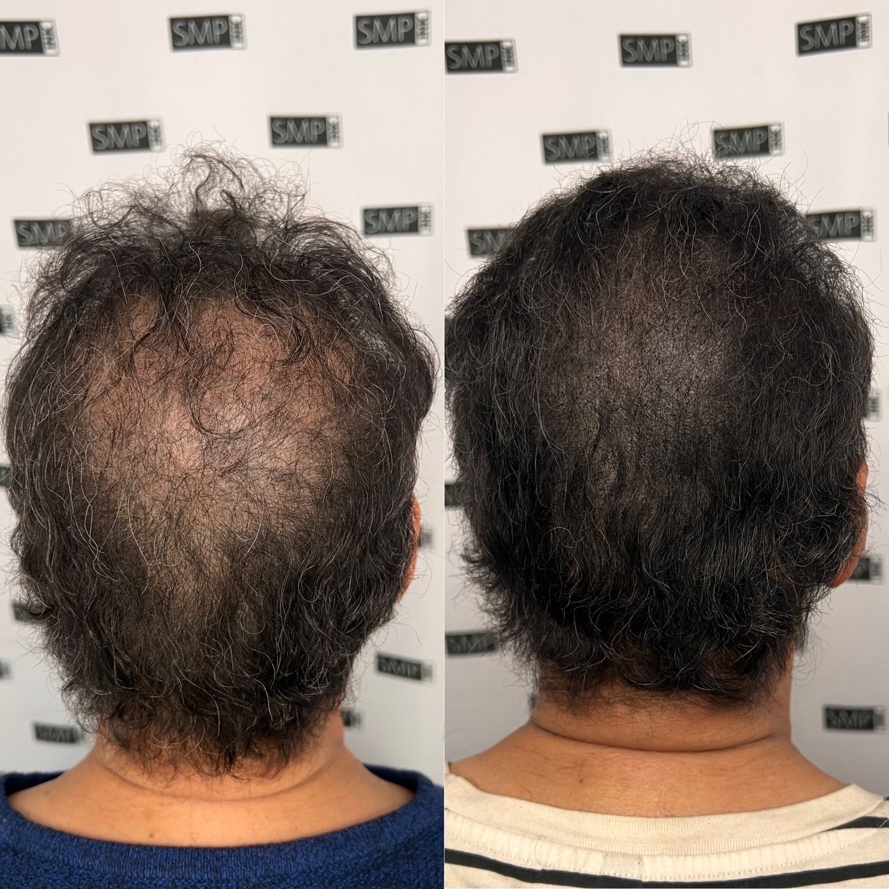 Before and after photos of a person's head. Shows improved hair density after scalp micropigmentation.