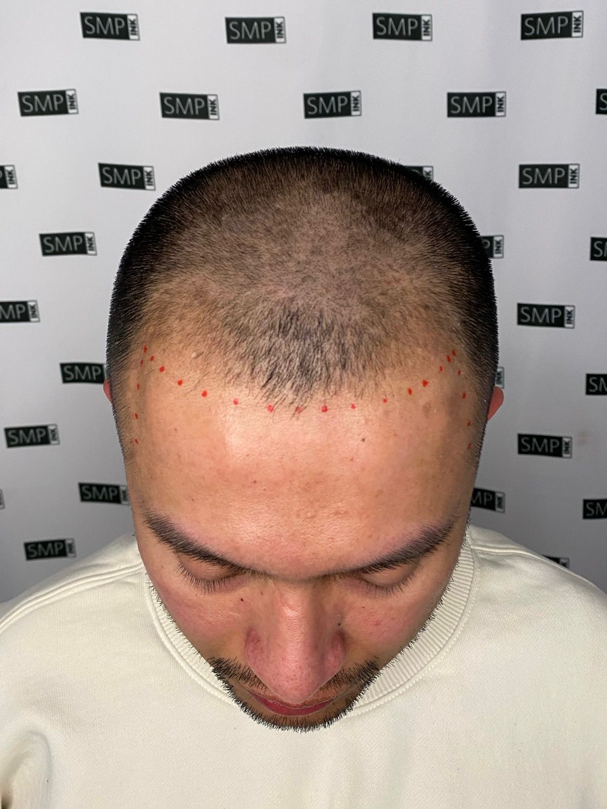 Man with shaved head, scalp micropigmentation treatment; red dots mark hairline.