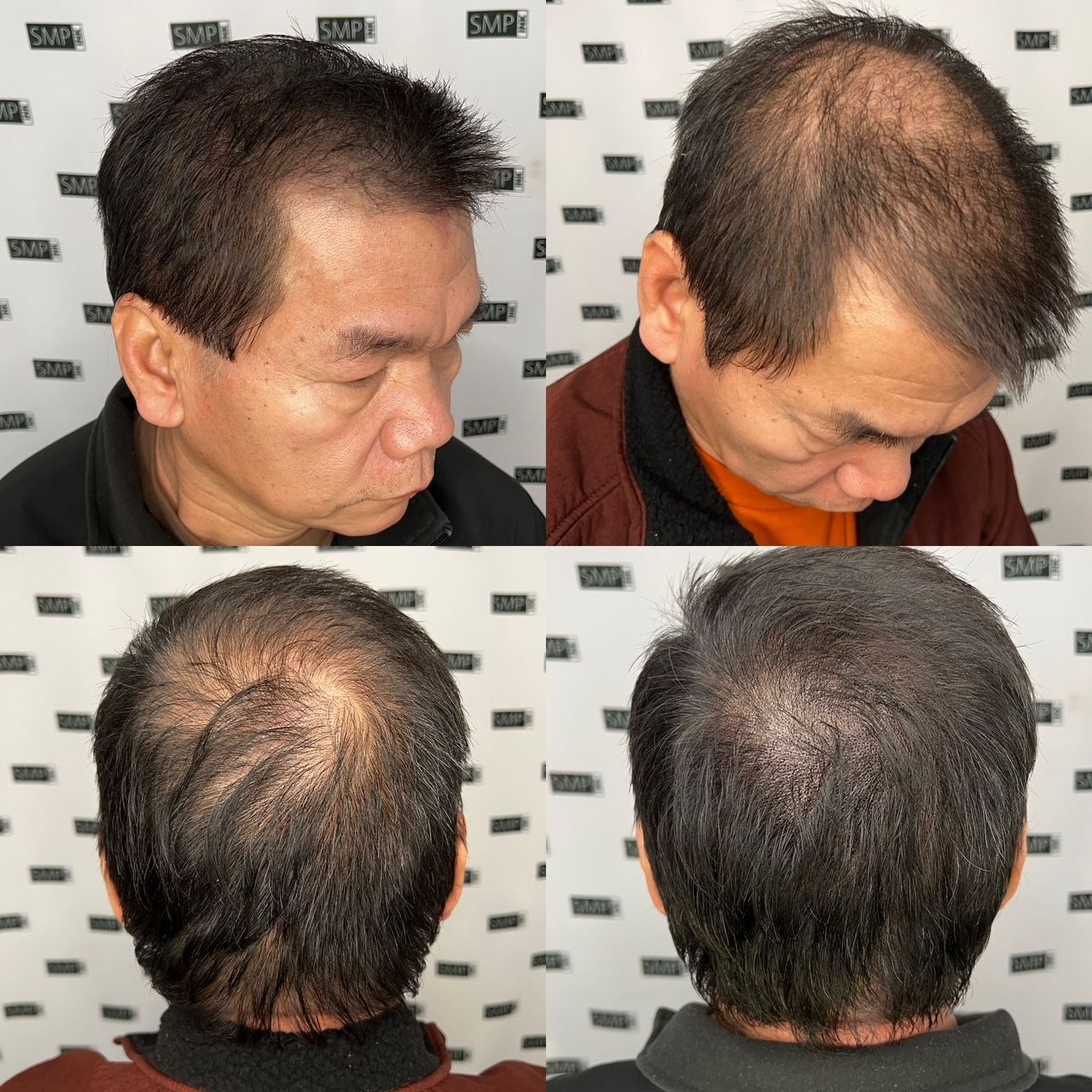 Hair restoration before and after photos; man with thinning hair, showing improvement after treatment.