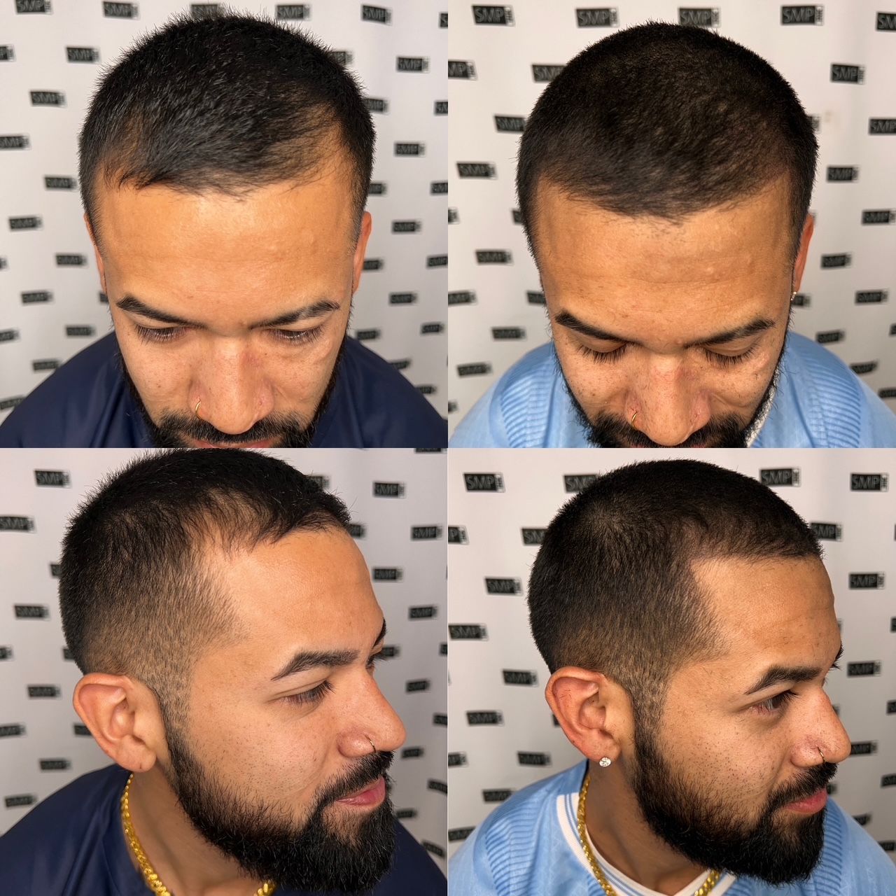 Four-panel collage showing a man's hair transformation: thinning hair to a neat, short haircut.