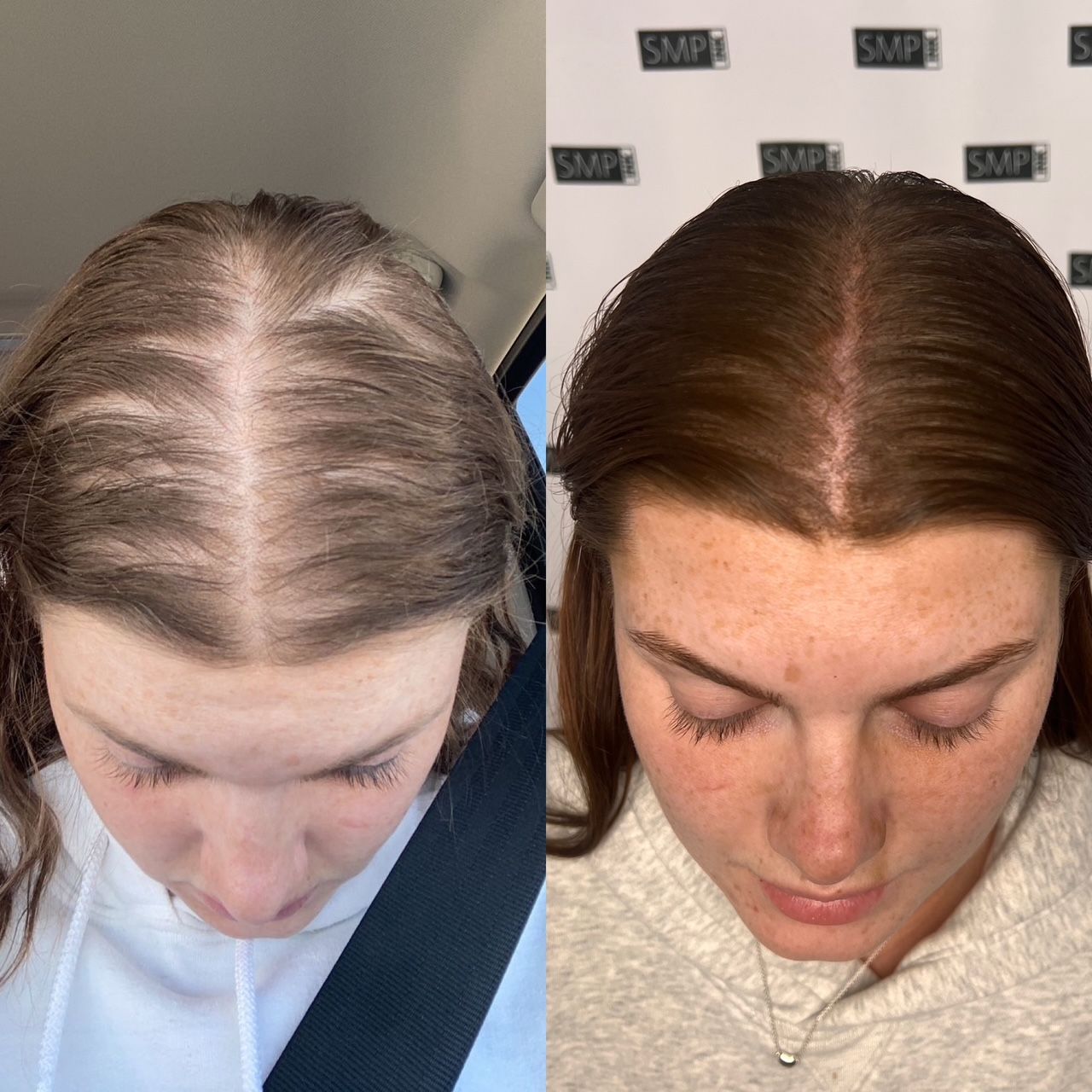 Before and after photos show a woman with hair loss, then with scalp micropigmentation.