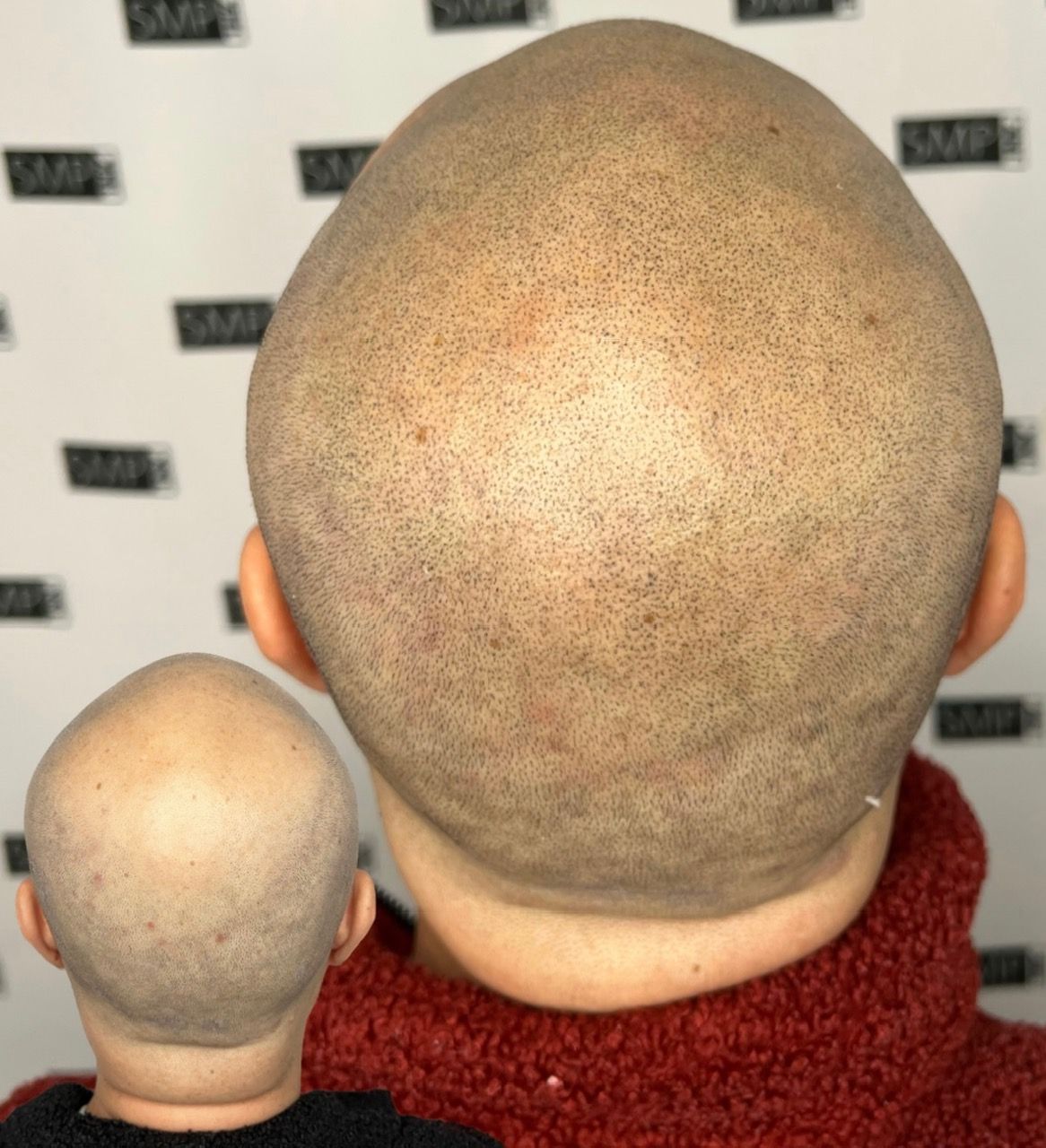 Back of a bald head, speckled with small dots, with a smaller version in the bottom left corner; person wears a red sweater.