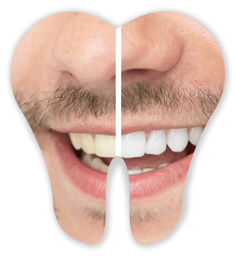 Tooth Whitening Preview — Germantown, TN — Mark A. Skidmore, DDS
