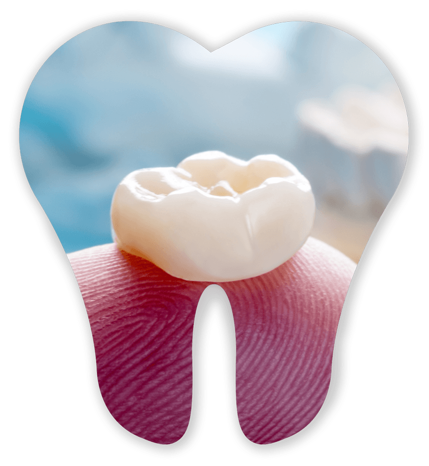 Single Dental Crown — Germantown, TN — Mark A. Skidmore, DDS