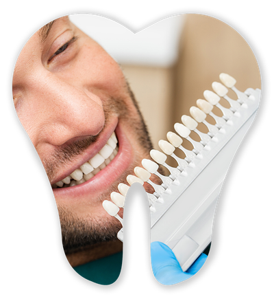 Tooth Veneers Selection — Germantown, TN — Mark A. Skidmore, DDS