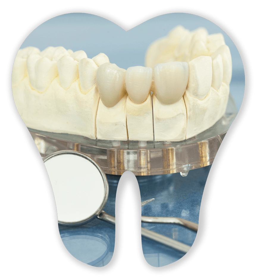 Dental Bridges Model — Germantown, TN — Mark A. Skidmore, DDS