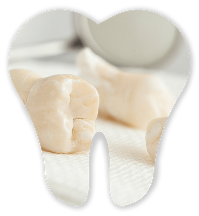 Wisdom Teeth Extraction — Germantown, TN — Mark A. Skidmore, DDS