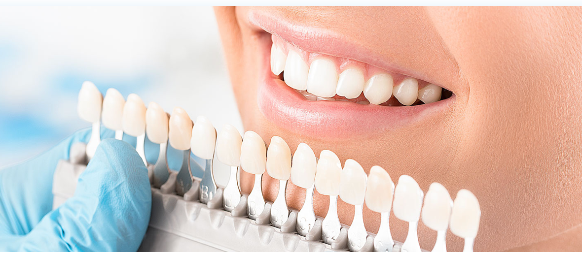 A person's smile with a shade guide used to match teeth color for dental work.
