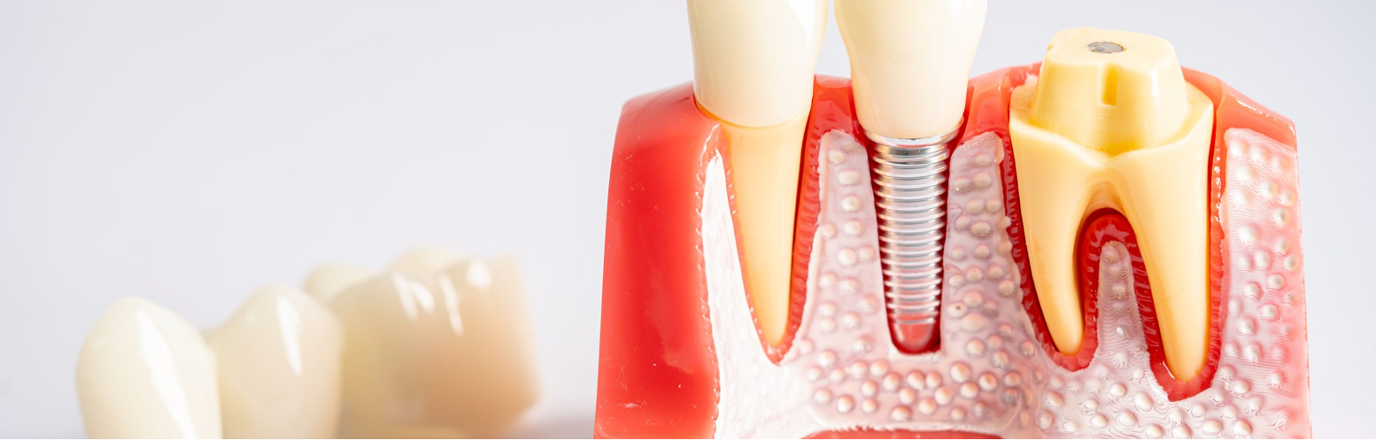 Dental implant model showing the process with surrounding teeth.