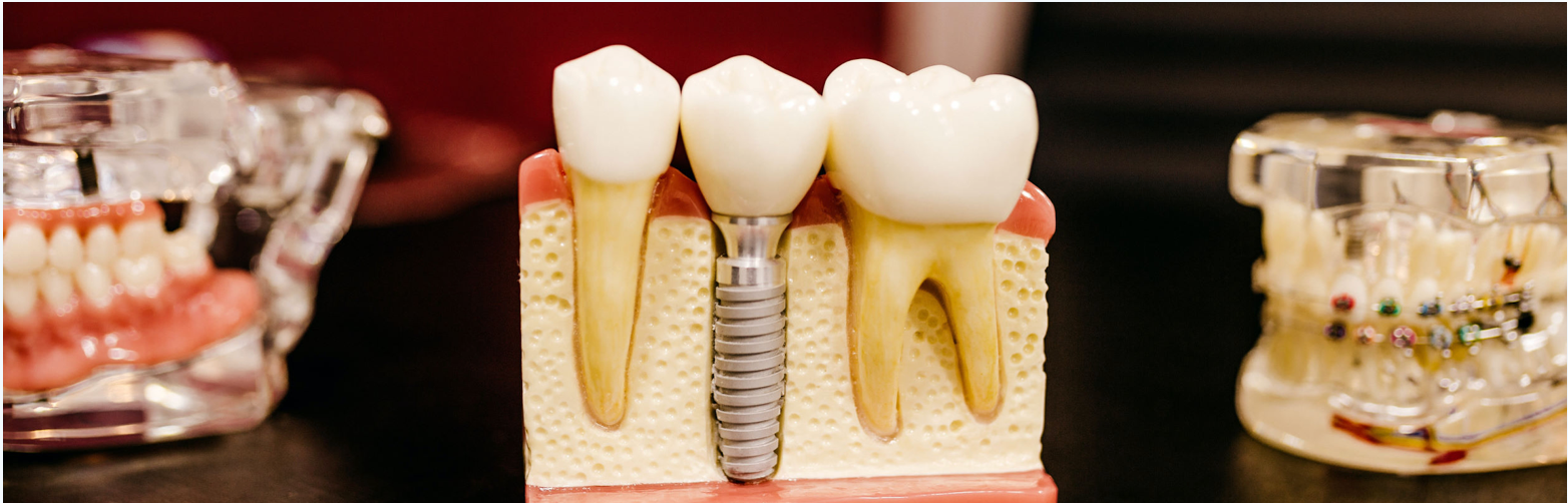 Model of a dental implant and teeth, showing the implant, root, and crown.