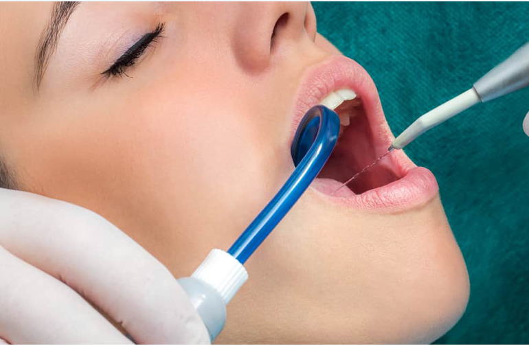 Dental cleaning with a dental mirror and tool, in an open mouth, close-up.