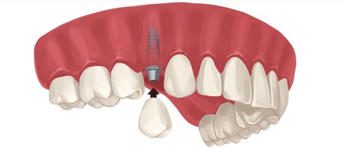 Dental implant procedure illustration. A tooth is being attached to a metal post in the gums.