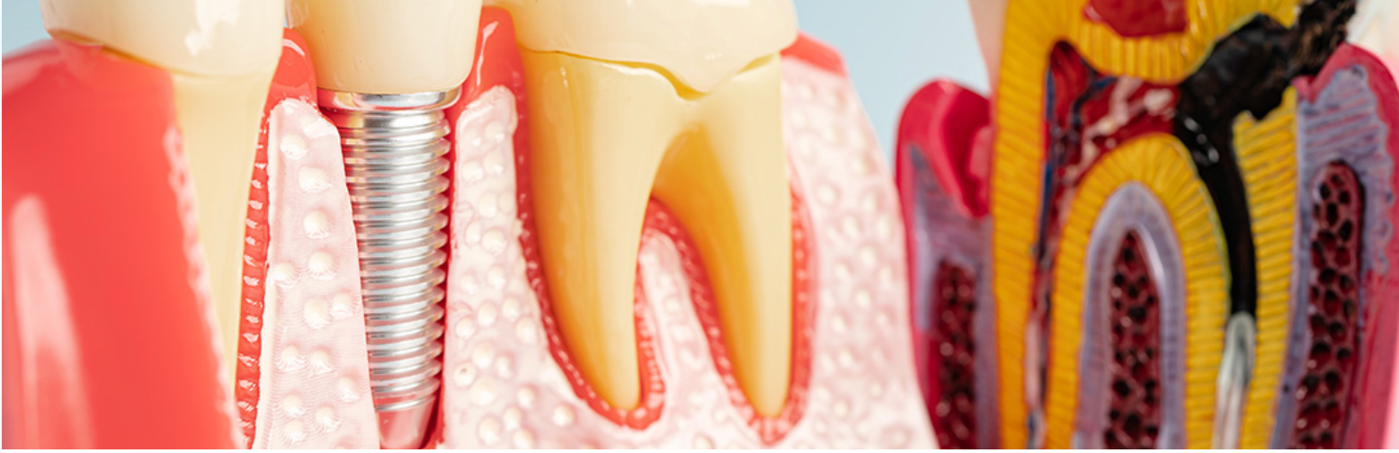 Dental model showing a tooth implant, a natural tooth, and a tooth with decay, highlighting dental health.