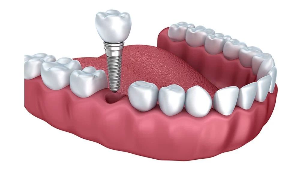 Model of lower jaw with dental implant and surrounding teeth.