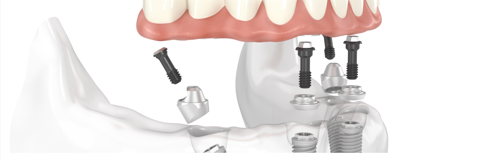 Diagram of dental implants with dentures, illustrating the implant procedure.