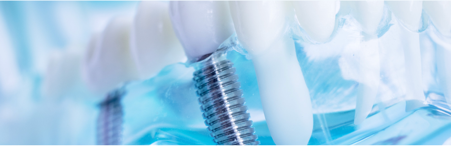 Dental implants, teeth and gums, blue and white.
