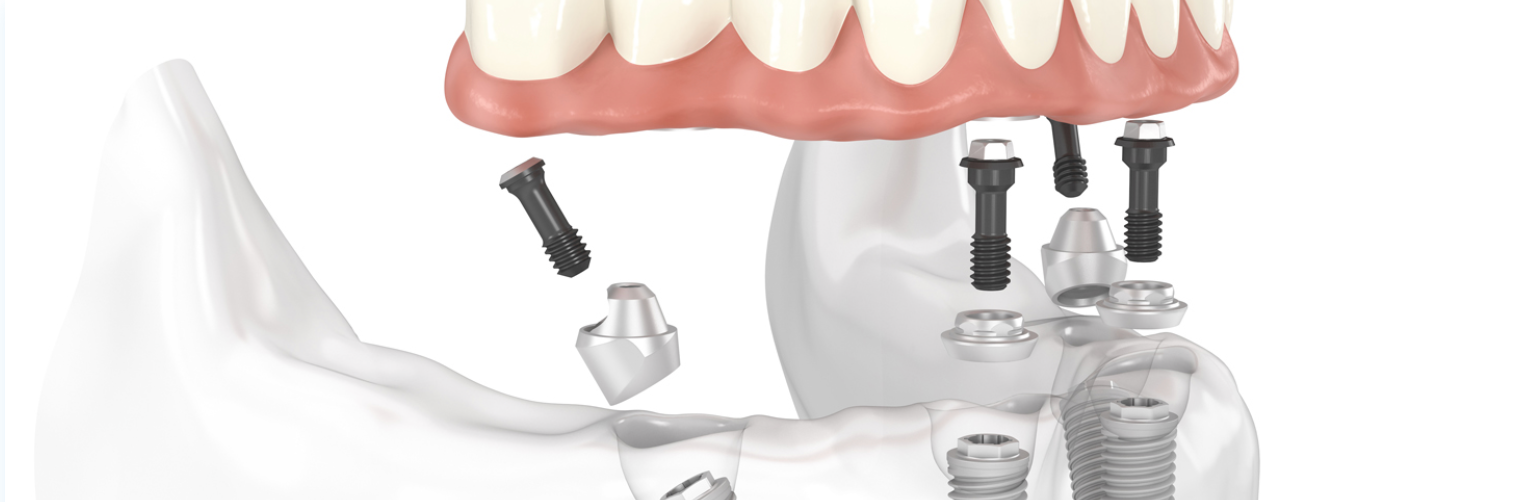 Dental implants: Upper teeth model with abutments and screws, illustrating implant placement.