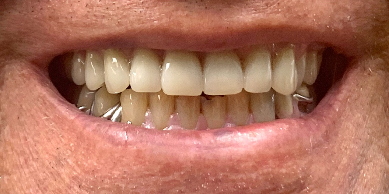 A close up of a man 's mouth with his teeth showing.