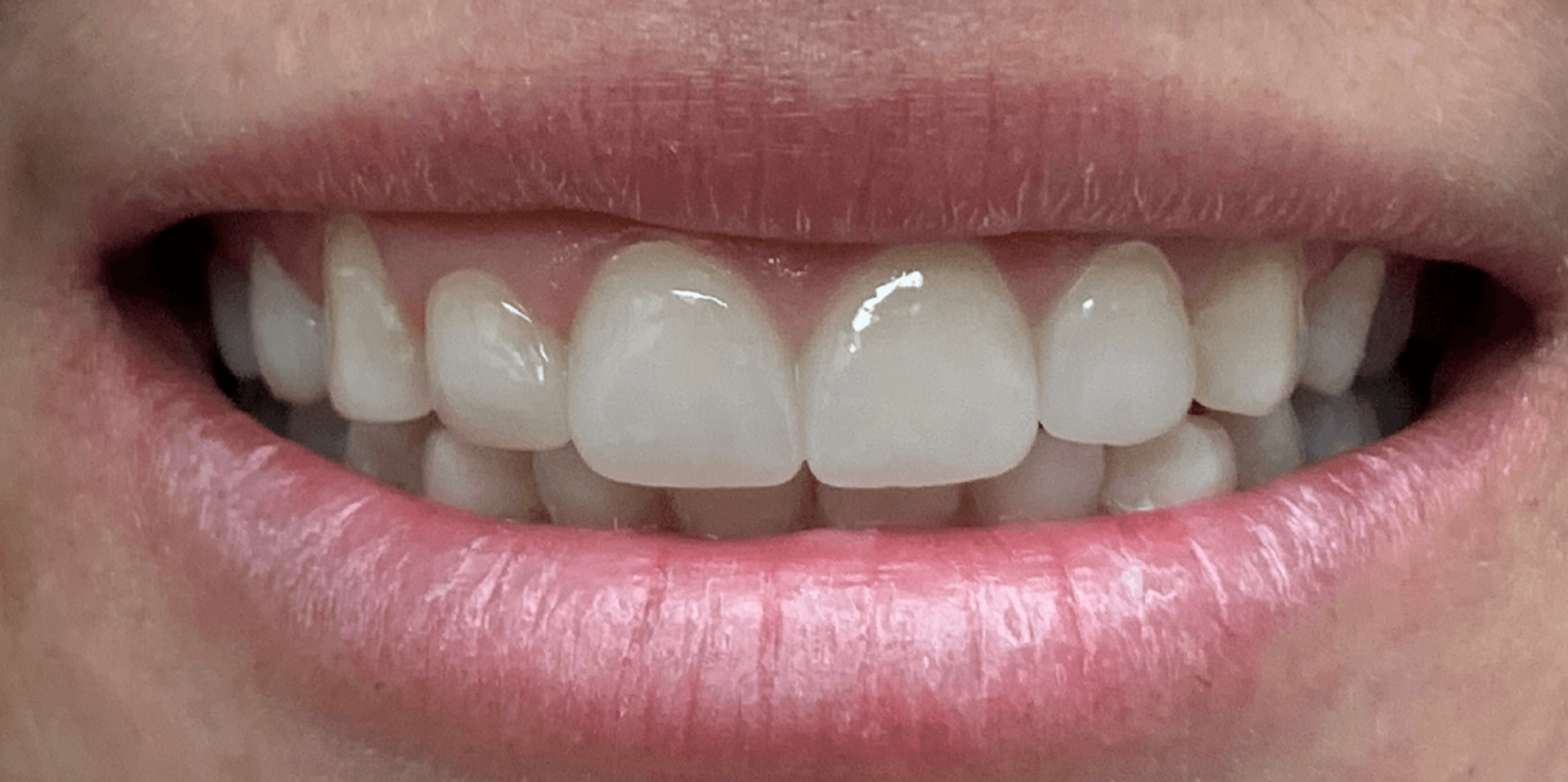 A close up of a woman 's smile with white teeth and pink lips.