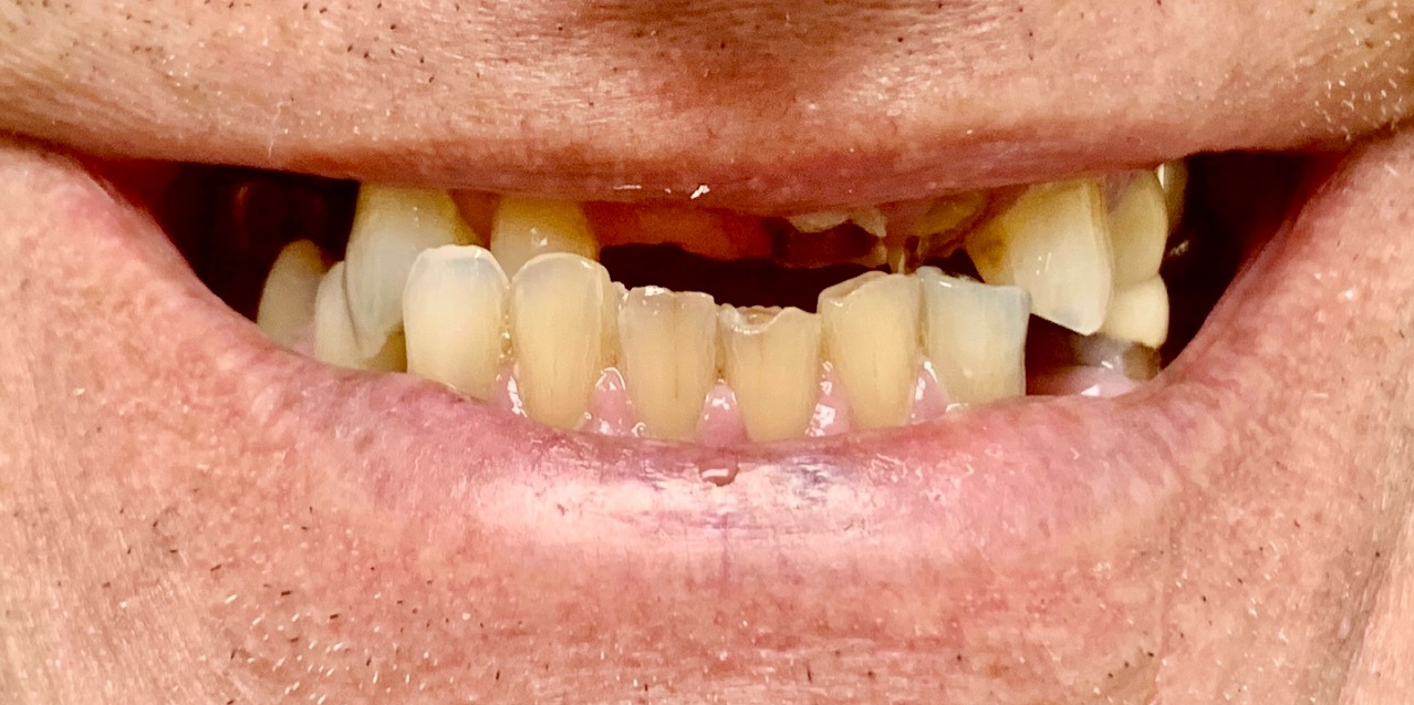 A close up of a man 's mouth with missing teeth.