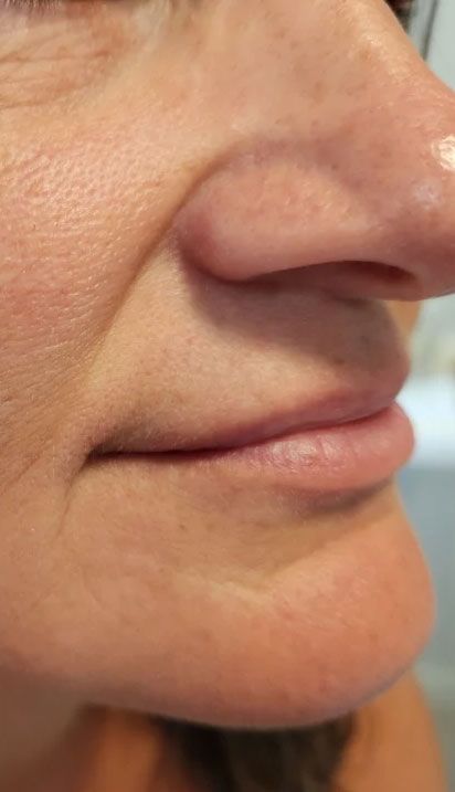 Close-up profile view of a person's nose, lips, and chin. Skin is lightly textured.