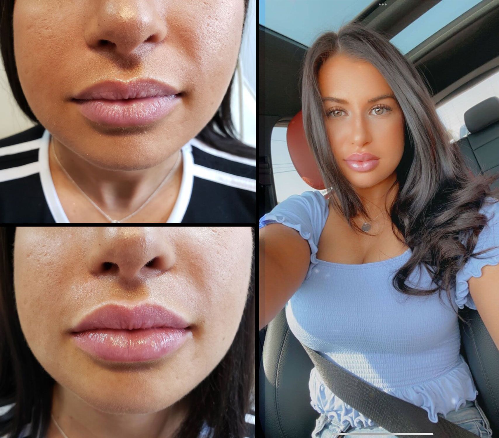 Before and after lip filler: woman's lips before and after, with a portrait of her after the procedure.