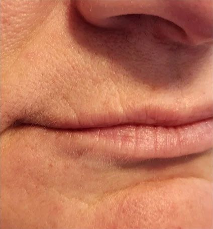 Close-up of a person's face, showing the lower nose, lips, and surrounding skin. Skin is lightly textured.