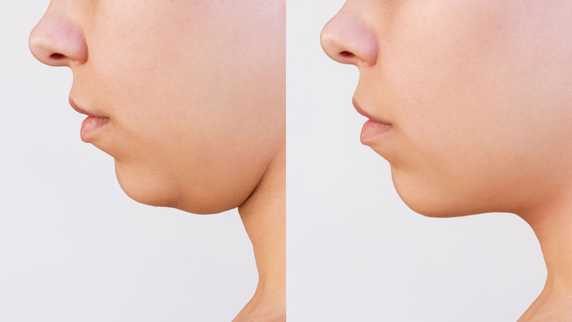 Profile view of a face with a double chin before (left) and after (right) a cosmetic procedure.