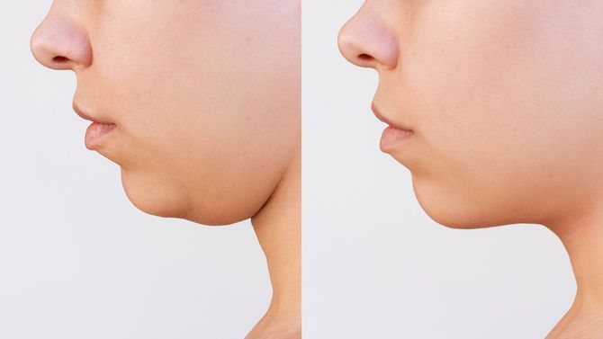 Profile view of a face with a double chin before (left) and after (right) a cosmetic procedure.