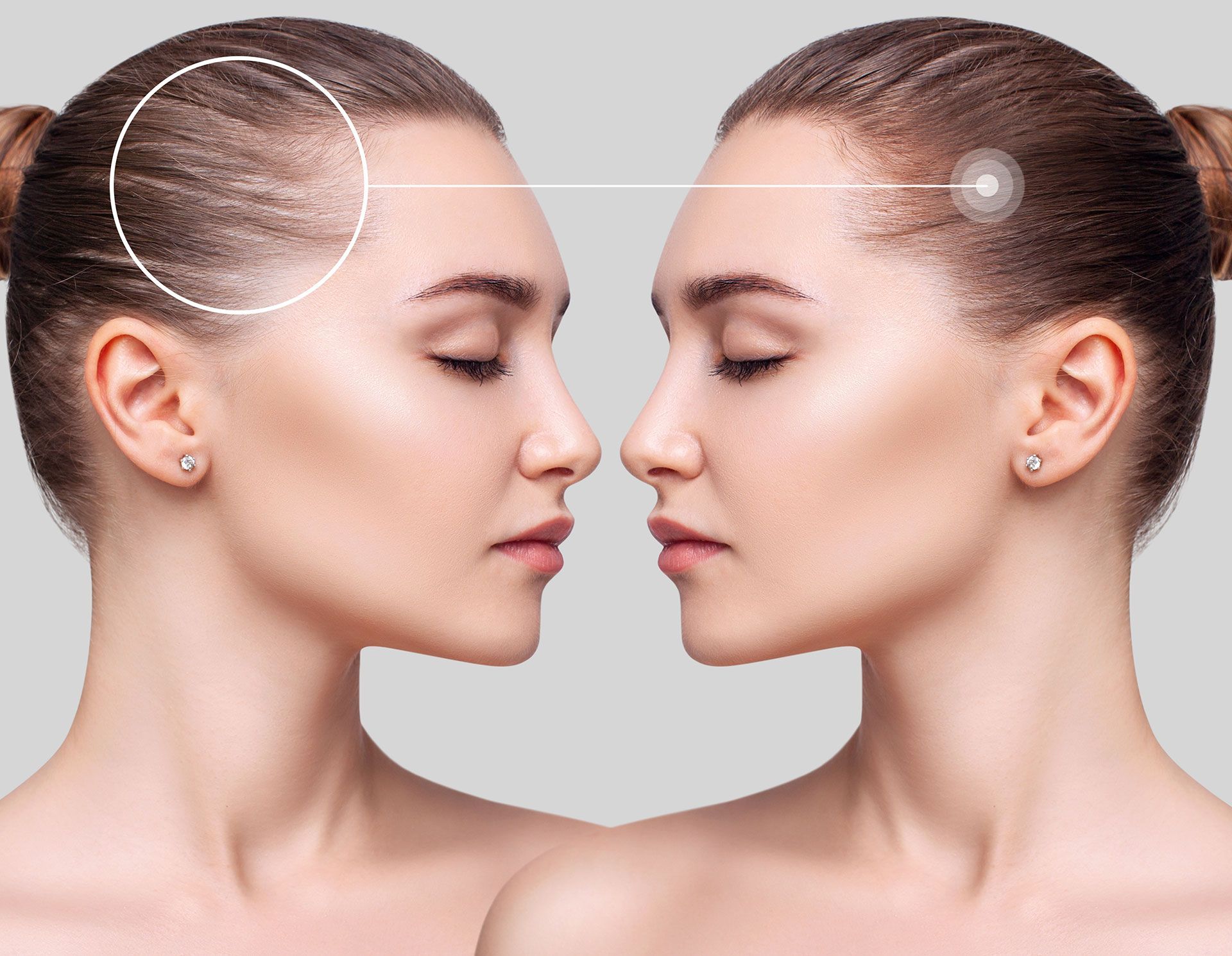 Comparison of a woman's hairline: before and after hair restoration, featuring thinning hair and a full hairline.