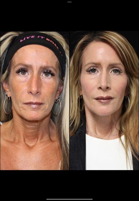 Before and after photos of woman; left: aged appearance; right: younger, smoother skin.