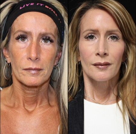 Before and after photos of a woman's face showing a facelift, with a smoother appearance.