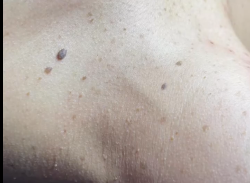 A close up of a person 's chest with a lot of moles on it.