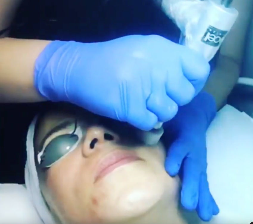 A woman wearing blue gloves is getting a treatment on her face