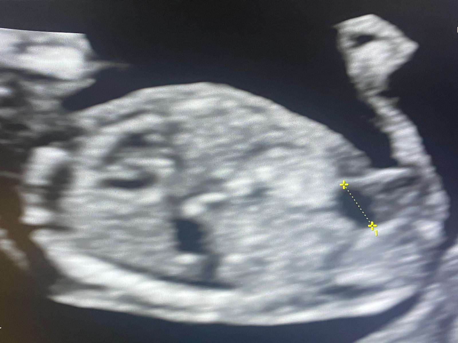 ecografia primo trimestre