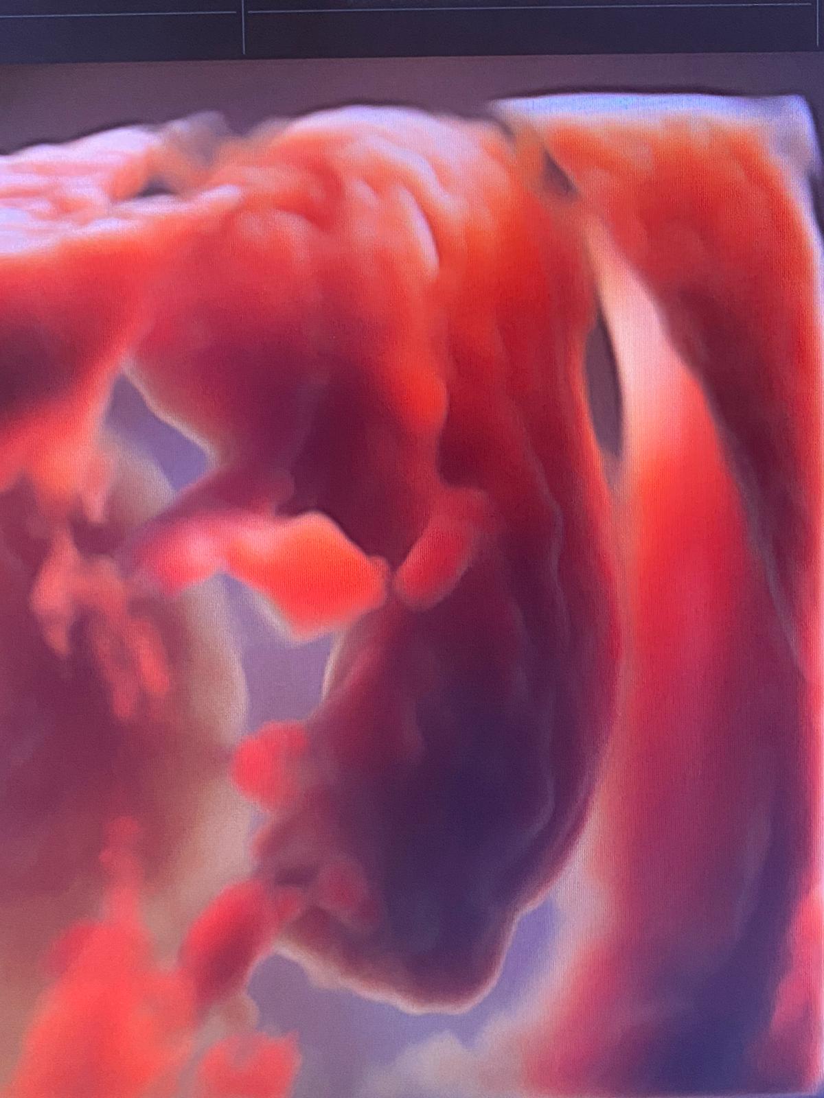 ecografia feto completo