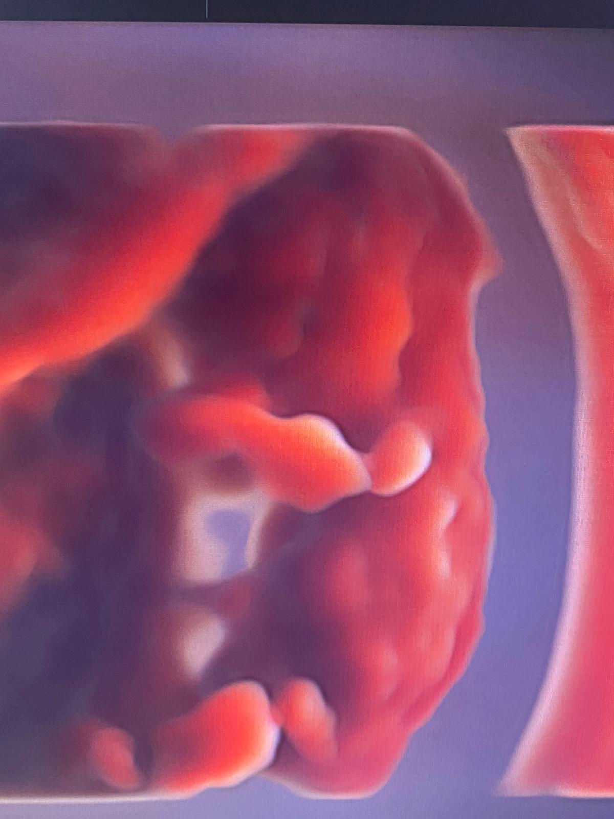 ecografia tridimensionale