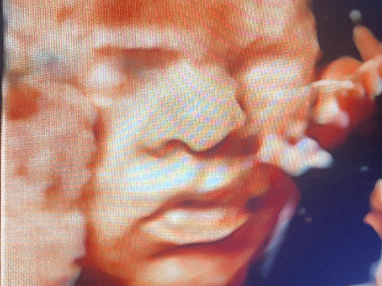 ecografia muso bambino