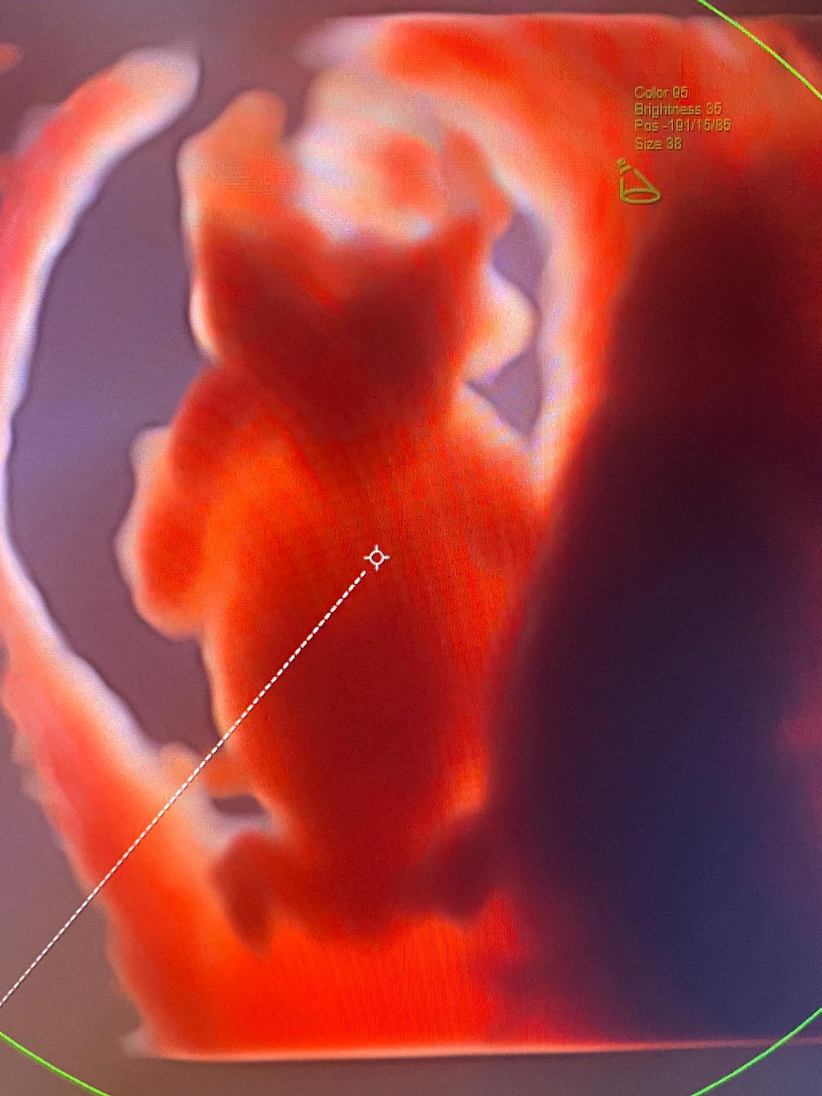 ecografia terzo trimestre