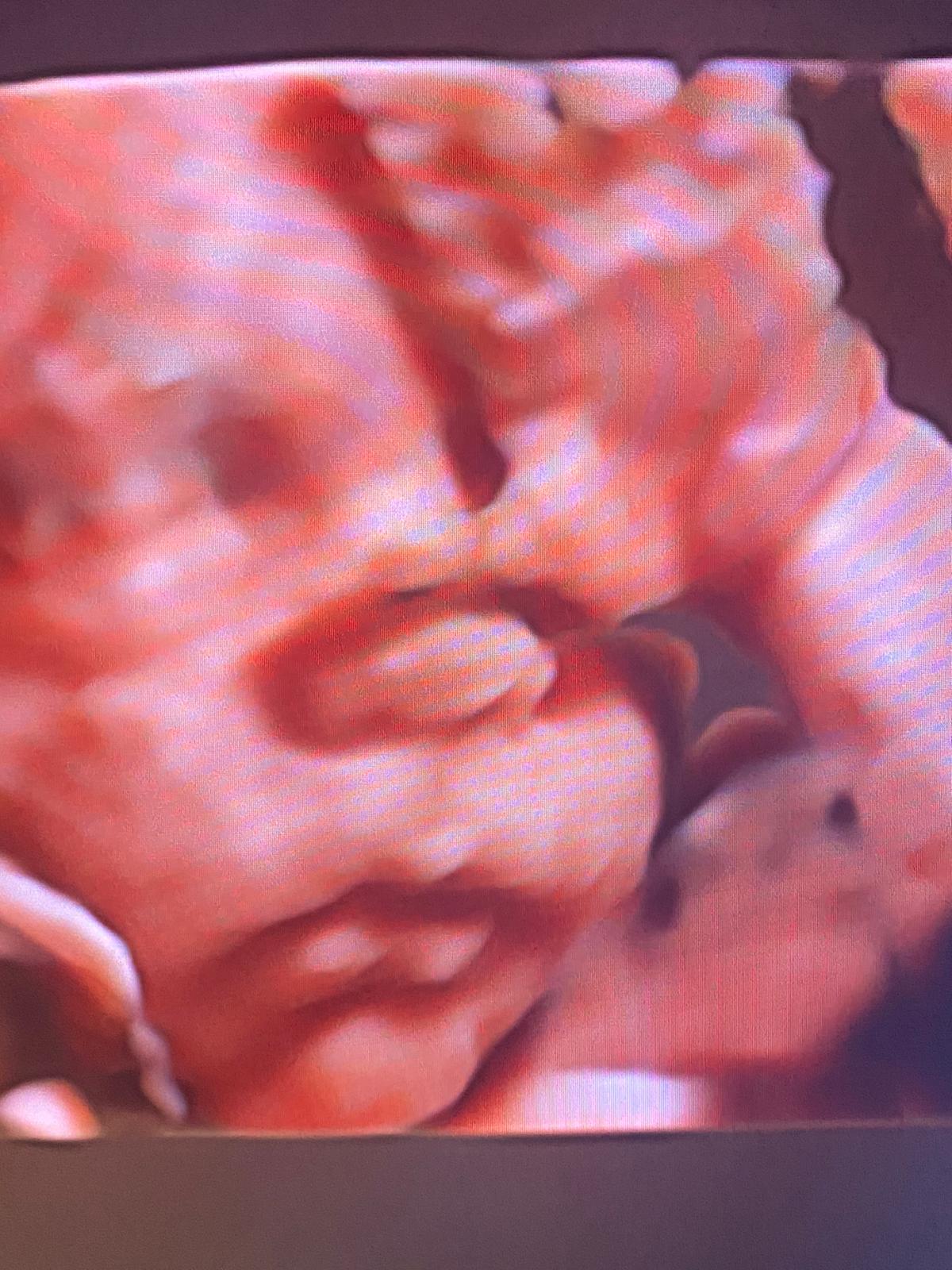 ecografia accrescimento feto